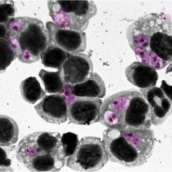leishmaniasis 